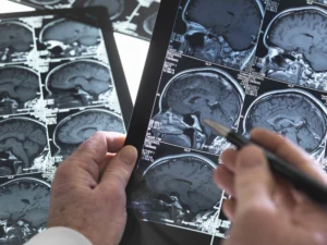 Understanding the Different Types of Traumatic Brain Injury (TBI)